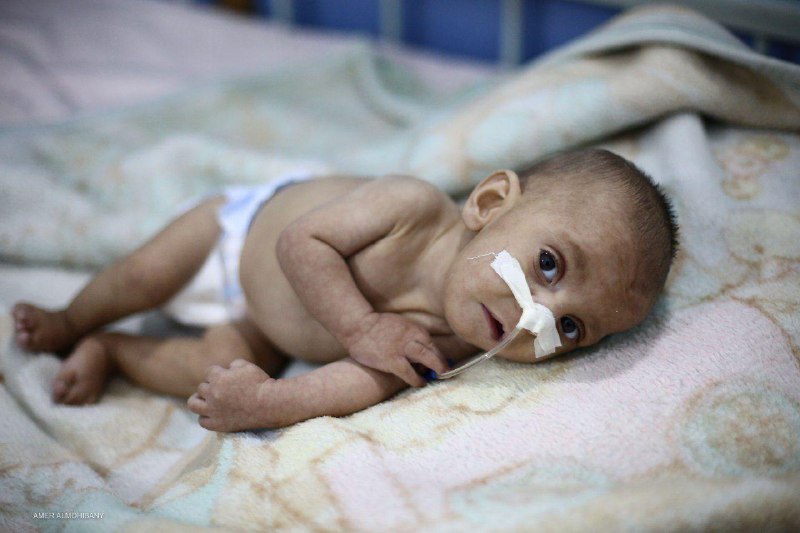 الموت يحاصر أطفال الغوطة: وفاة طفل آخر نتيجة سوء التغذية الحاد